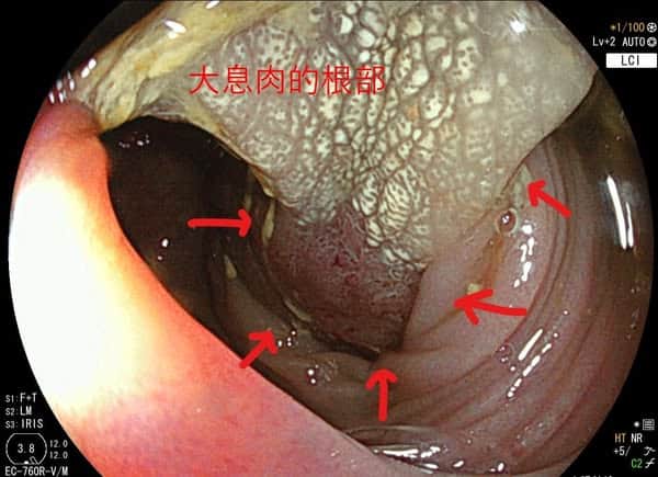 40歲夫妻來做無痛腸胃鏡，乙狀結腸發現大息肉，用內視鏡從大息肉的根部切除它，