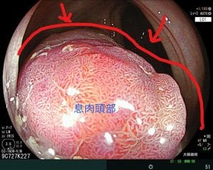 40歲夫妻來做健檢，選擇無痛腸胃鏡，乙狀結腸發現大息肉，用內視鏡切除它，今天病理報告出來了，兩顆息肉都是原位癌。有願才有力。你願意將身體交給我們照顧，我們就該盡力承擔一些未知，來增加你的幸福機率。因為剛好遇見你。