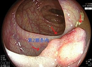 40歲夫妻來做健檢，選擇無痛腸胃鏡，乙狀結腸發現大息肉，用內視鏡切除它，今天病理報告出來了，兩顆息肉都是原位癌。有願才有力。你願意將身體交給我們照顧，我們就該盡力承擔一些未知，來增加你的幸福機率。因為剛好遇見你。
