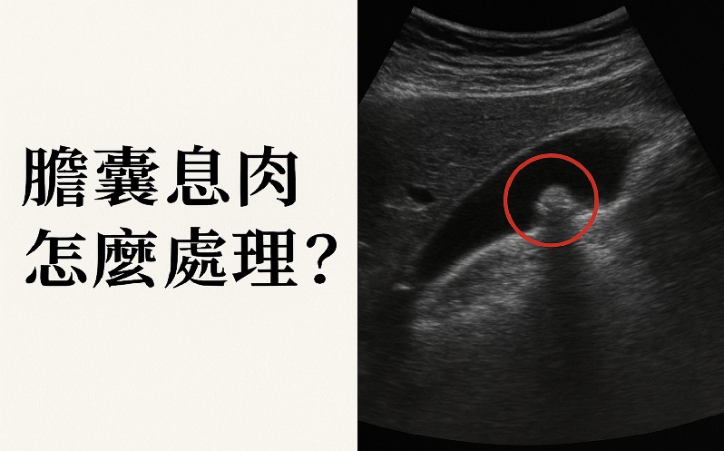 膽囊息肉怎麼處理