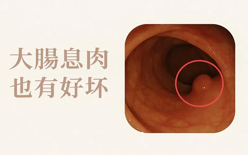 大腸息肉也有好壞